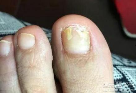 婆婆妈妈爆料灰指甲视频 第1张 婆婆妈妈爆料灰指甲视频 第1张